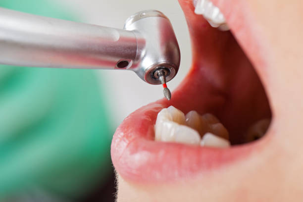 Best Emergency Tooth Extraction in Ucon, ID